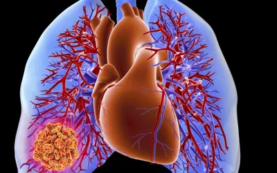 Pulmonary embolism declared a silent but deadly disease