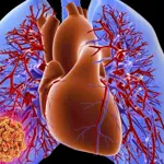 Pulmonary embolism declared a silent but deadly disease