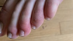 COVID Toes: Latest possible sign of coronavirus