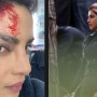 Priyanka Chopra gets injured while shooting for ‘Citadel’
