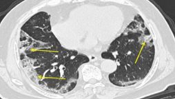 COVID-19 infections accelerate lung aging: study