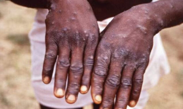 A rare incidence of monkeypox has been detected in England