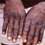 A rare incidence of monkeypox has been detected in England