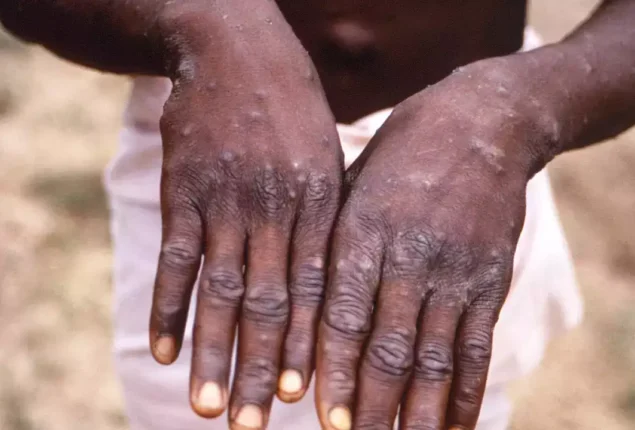 WHO declares monkeypox a global emergency