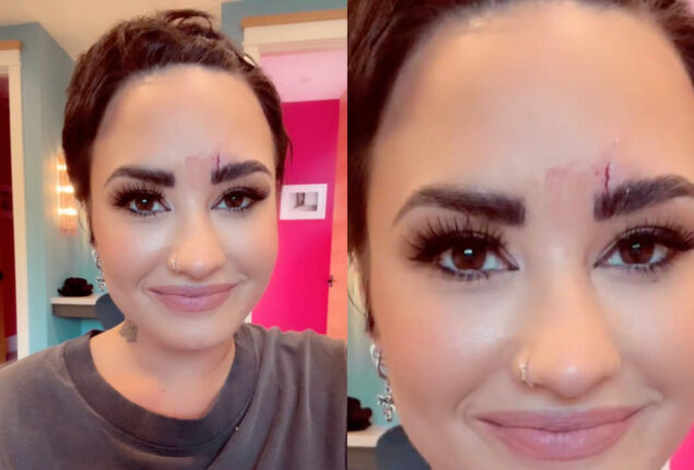 Demi Lovato gets three stitches after smashing a giant crystal on forehead
