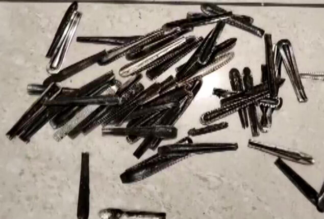 Doctors remove 62 steel spoons from man’s stomach after one year