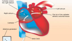 cardiac ablation