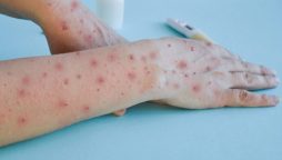 Pakistan reports second case of Monkeypox