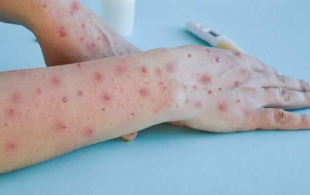 Pakistan reports second case of Monkeypox