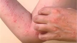 NIH issues health advisory about Chikungunya